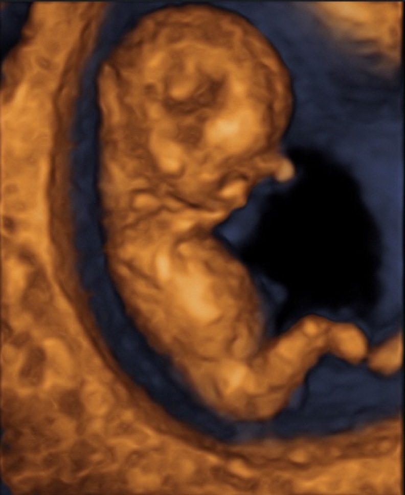 Embryo in der 13.Woche Embryo in der 13.Woche
